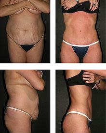abdominoplastika.jpg