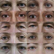 blefaroplastika.jpg